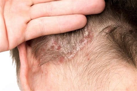 Understanding Psoriasis And Its Various Forms The Best Of Health