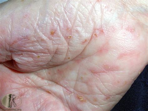 What Does Scabies Look Like Scabies Home Remedies