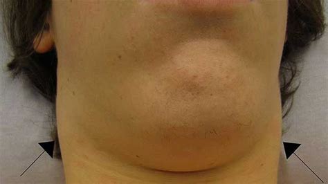 Lumps In Neck Under Jaw Renew Physical Therapy