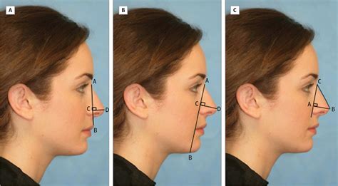 Nasal Tip Projection And Rotation In Young Women Facial Plastic