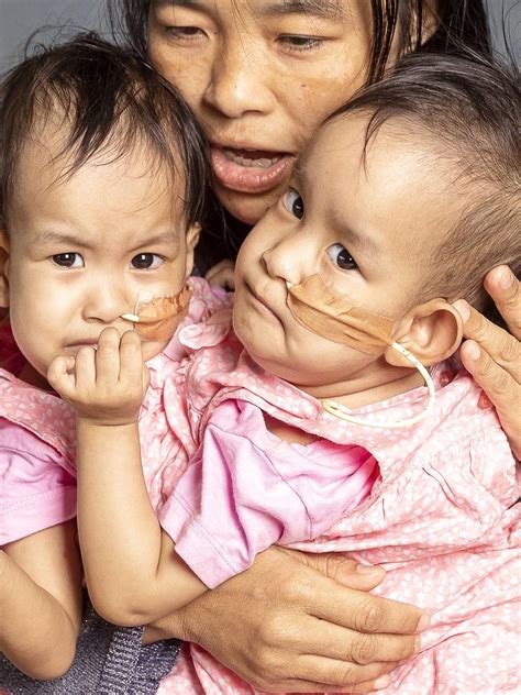 conjoined bhutanese twins undergo separation surgery in melbourne