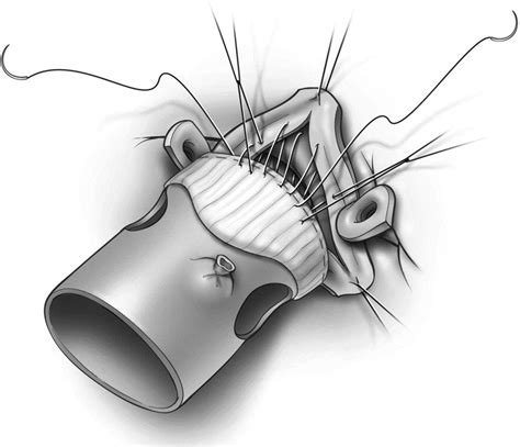 Stentless Aortic Bioprosthesis For Disease Of The Aortic Valve Root