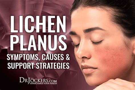Lichen Planus Symptoms Causes And Support Strategies