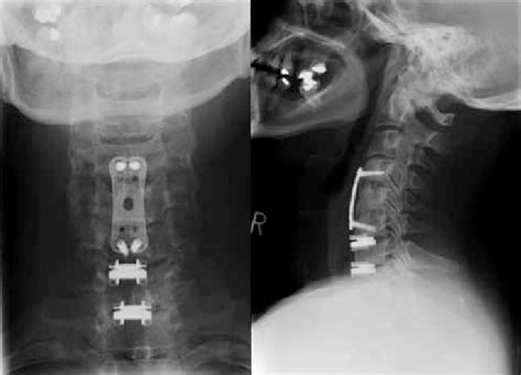 Figure Radiographs Showing Previous Anterior Cervical Discectomy And Download Scientific