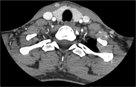 A Contrast Ct Axial Scan Of The Thyroid Gland Demonstrating No Obvious