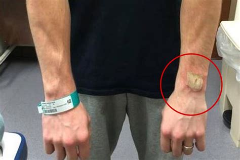 Man Describes Horrifying Moment Fitbit Exploded On His Wrist Leaving