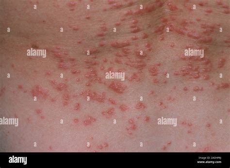 Scabies Skin Infection View Of Red Papules Lumps On The Skin Due To