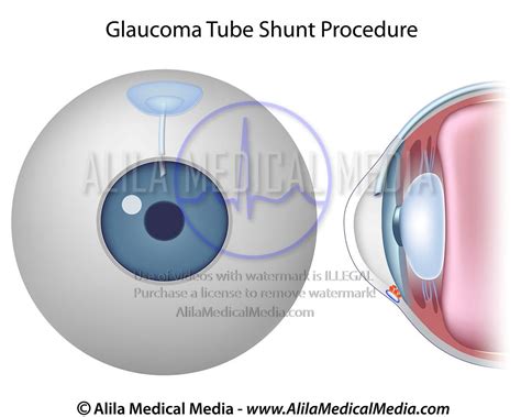Alila Medical Media Glaucoma Tube Shunt Procedure Medical Illustration