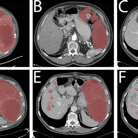 Ct Images Of Patient 1 Primary Gist Red Area Liver Metastases Red