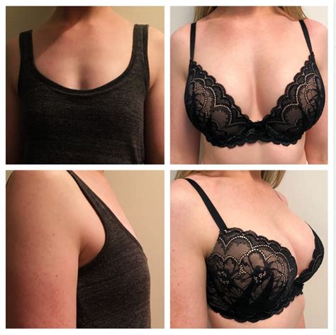 Before And After Breast Augmentation 1 Rescu