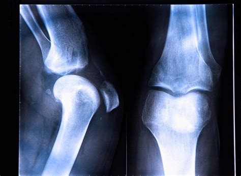 Causes Symptoms And Treatments Of Patellar Dislocation Facty Health