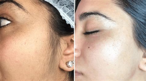 Dermaplaning Treatment Perfection Cosmetic