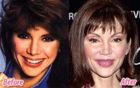 Stars Before And After Plastic Surgery 47 Pics