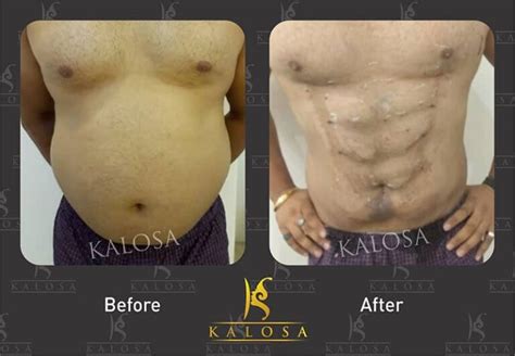 Six Pack Abs Surgery Gallery Kalosa Plastic Surgeon Clinic