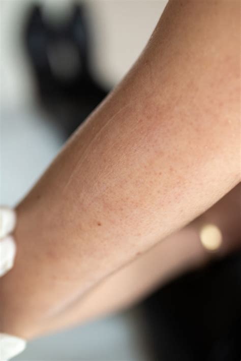 Bitsandbobsbyeva Laser Behandlung Bei Reibeisenhaut Keratosis Pilaris