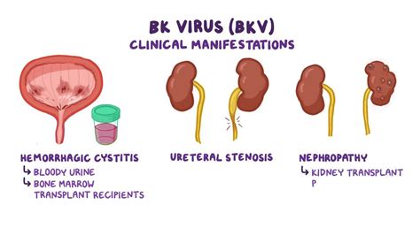 Bk Virus Hemorrhagic Cystitis Video And Anatomy Osmosis
