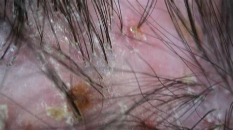 Folliculitis On Face Treatment Doctor Heck