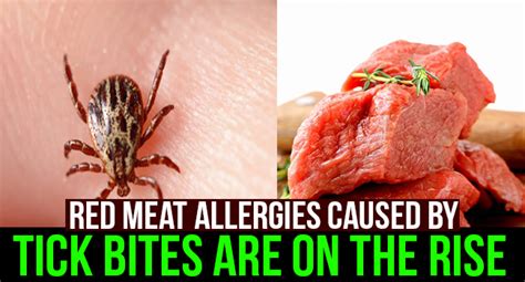 Red Meat Allergies Caused By Tick Bites Are On The Rise Allergy