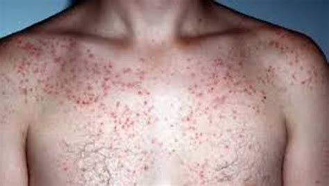 How To Get Rid Of Chest Acne Chest Acne Get Rid Of Chest Acne Anti