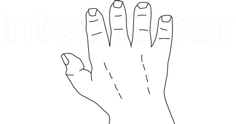 Drawing Of The Two Incisions Used For The Hand Compartment