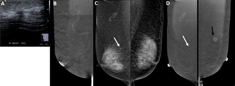 Contrast Enhanced Mammogram A New Game Changer In Breast Imaging
