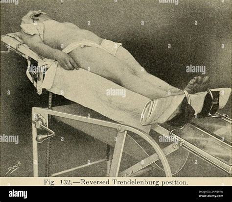 Lithotomy Position Hi Res Stock Photography And Images Alamy