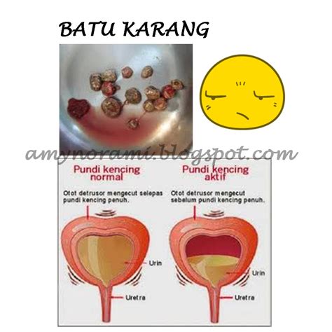 Sakit pada bahagian abdomen iaitu pada sisi kanan dan kiri pinggang. BATU KARANG : Punca Batu Karang Terbentuk Dan Rawatannya ...