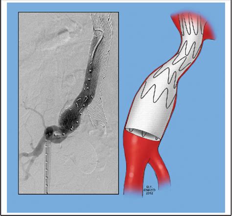 Figure 1 From Pelvic Revascularization During Endovascular Aortic