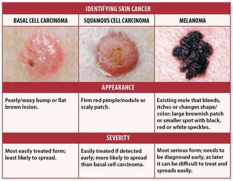 Skin Cancers Diagram Quizlet