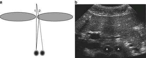 Spatial Resolution Artifact Ultrasound Get Images