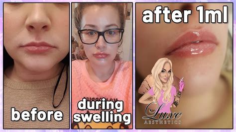 natural lip filler experience 1ml before and after lip injections luxe aesthetics