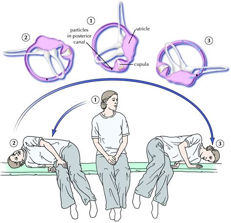 Diagnosis And Management Of Benign Paroxysmal Positional Vertigo Bppv