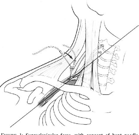 Figure 1 From Supraclavicular Regional Anaesthesia Revisited The Bent