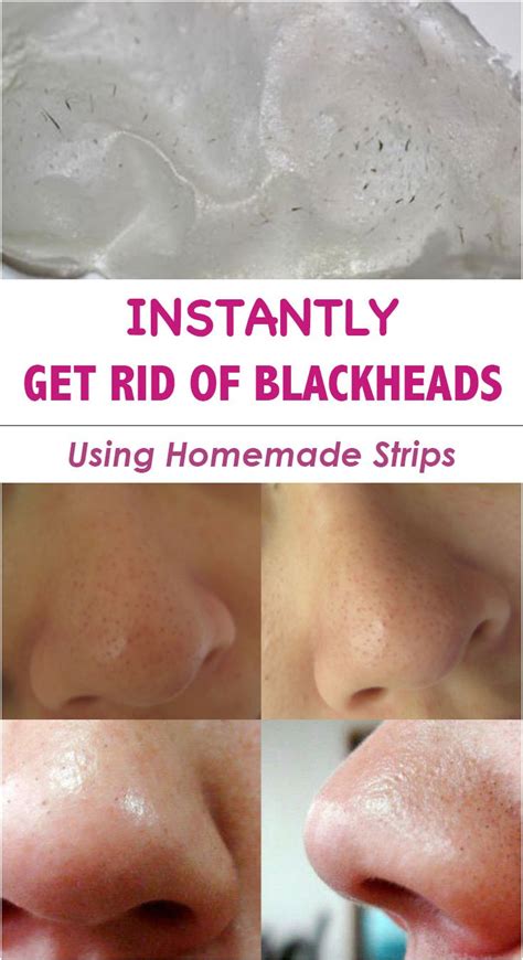 Get Rid Of Blackheads Using Homemade Strips Everything In One Place