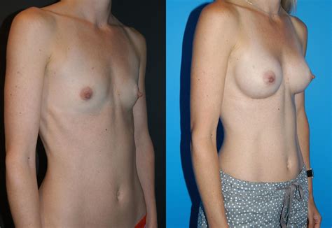 Breast Augmentation With Implants In Vancouver Dr Peter Lennox