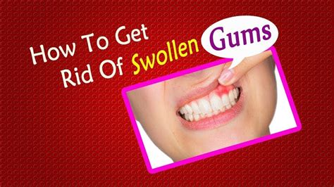 How To Get Rid Of Swollen Gums Home Remedies For Gums Swelling Youtube