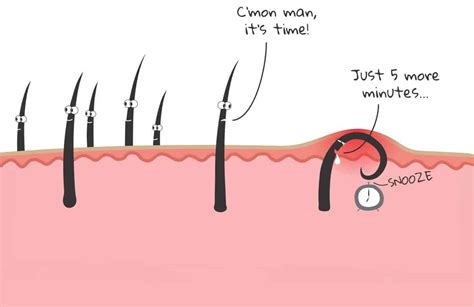 Ingrown hairs occur when hair curls around and grows back into the skin or if dead skin clogs the hair follicle and forces it to grow sideways. How To Get Rid Of Ingrown Facial Hair (Causes, Prevention ...