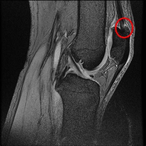 Missed Diagnosis Of Enthesitis Related Arthritis