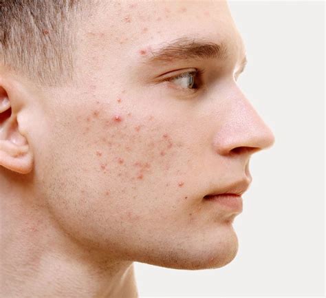 The Easiest Way The Very Best Skincare Products For Your Acne Fitness