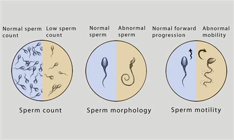 Male Infertility Factors That Affect Sperm Count And Morphology Hot