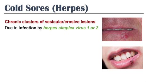 Herpes Types And Prevention Quick Ways To Get Rid Of Hsv 1and2 Youtube