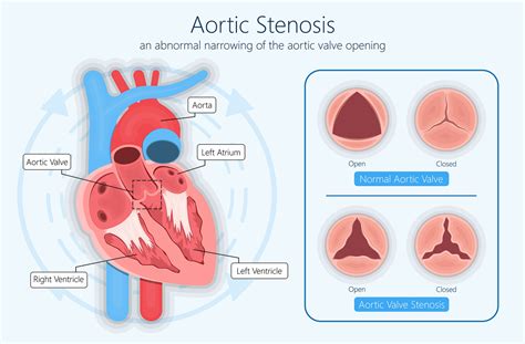 Aortic Valve Stenosis Symptoms And Treatment In Hyderabad