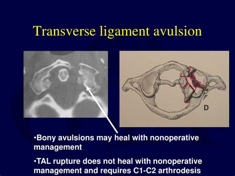 PPT - Upper Cervical Spine Fractures PowerPoint ...