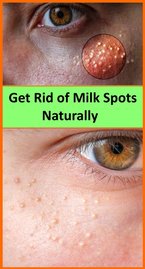 7 Remedies To Get Rid Of Milk Spots Naturally Health Skin Care Skin