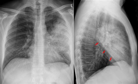 Lobar Pneumonia X Ray