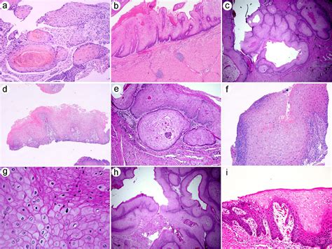 Histomorphology And Molecular Profiling Of Well Differentiated Squamous Cell Carcinoma Of The