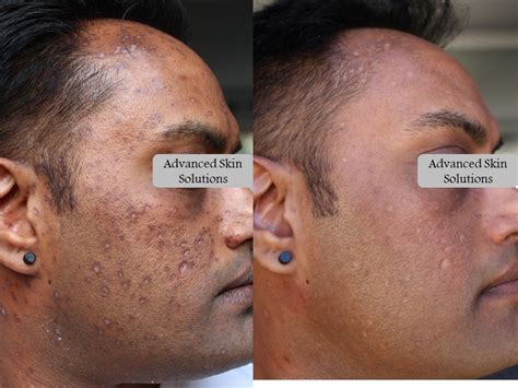 Acne Advanced Skin Solutions