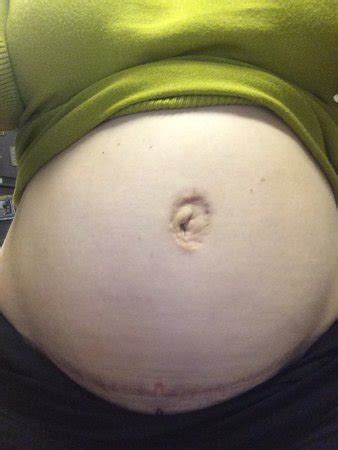 Will My Belly Button Come Back After Pregnancy Siambookcenter