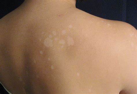 You can try things like exfoliation or a warm compress to help clear it up. White Spots On The Skin - Life Health Max