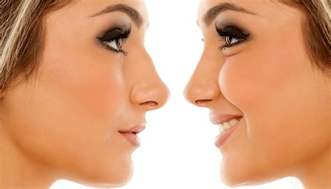 Moynihan — one of the top rhinoplasty surgeons in chicago — has developed his own, innovative techniques for nasal improvements. Is Rhinoplasty or a Non-Surgical Nose Job with Bellafill ...